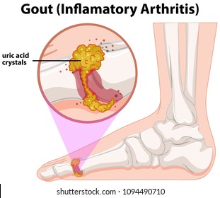 A Medical Human Anatomy Gout illustration