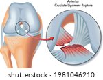 Medical Illustration of anterior cruciate ligament rupture.