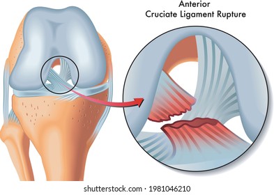 Medical Illustration of anterior cruciate ligament rupture.