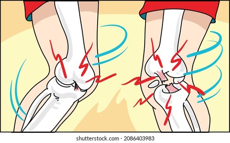 Medical Illustration of anterior cruciate ligament rupture. 