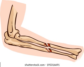 medical illustration of arm bone