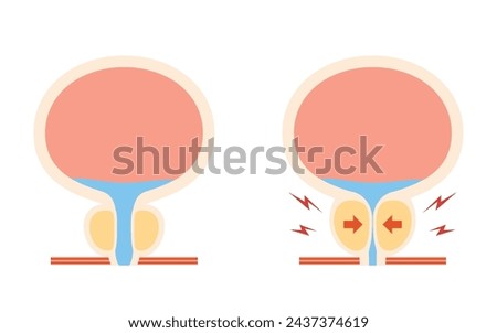 Medical illustration of benign prostatic hyperplasia, normal vs. enlarged prostate, Vector Illustration
