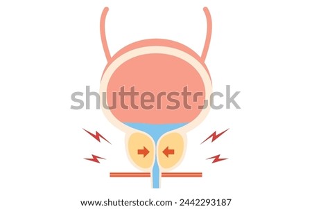 Medical illustration of benign prostatic hyperplasia, normal vs. enlarged prostate, Vector Illustration