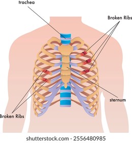 Medical illustration of broken ribs in the human body, with annotations.