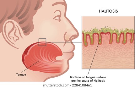 Medical illustration of the cause of Halitosis