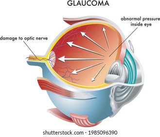 Medical illustration of the causes of glaucoma.