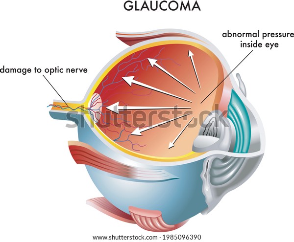 Medical illustration of the causes of glaucoma.