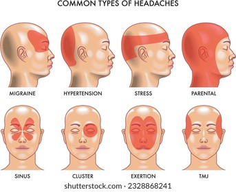 Medical Illustration of common types of headaches.