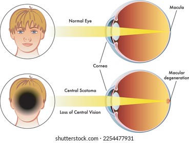 La ilustración médica compara un ojo humano con la escotoma central, con un ojo normal.