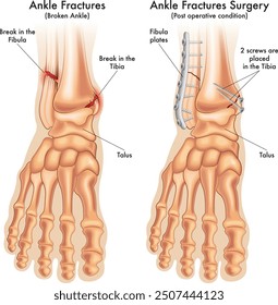 Die medizinische Abbildung vergleicht einen gebrochenen Knöchel vor und nach der Operation mit Anmerkungen.