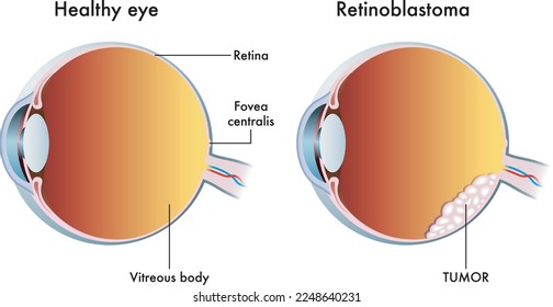 Medical illustration compares a healthy eye with one affected by retinoblastoma.