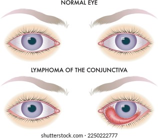 Medical illustration compares a healthy eye with one affected by lymphoma of the conjunctiva.