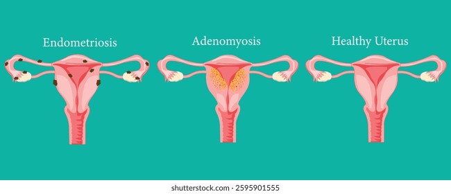 Medical illustration comparing endometriosis, adenomyosis, and a healthy uterus condition. eps 10