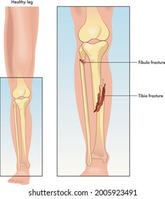 A Medical Illustration Comparing A Healthy Leg And A Leg With Fractured Tibia And Fibula.