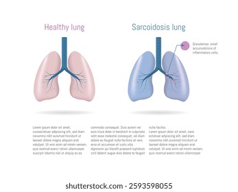 Medical illustration comparing healthy lung with sarcoidosis lung, highlighting granulomas and inflammation