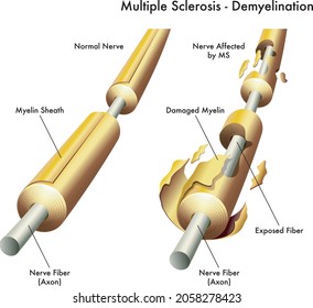 Medical illustration comparing healthy nerve with labelled one with damage caused by multiple sclerosis.