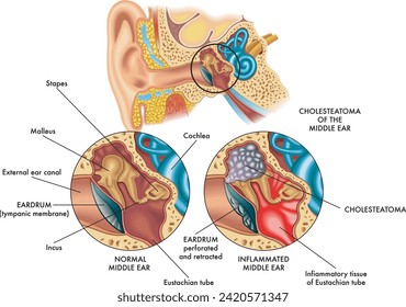 Medizinische Abbildung, die den inneren Teil des Ohrs (Mittelohr) auf der linken gesunden und auf der rechten Seite von Cholesteatoma beeinflusst, mit Anmerkungen vergleicht.