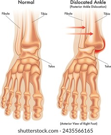 Medizinische Illustration zum Vergleich eines normalen Knöchels mit einem dislozierten Knöchel mit Anmerkungen.
