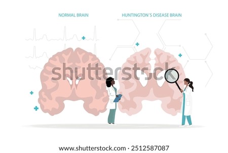 Medical illustration comparing a normal brain with one affected by Huntington's disease.