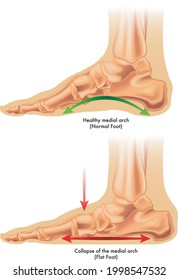 Medical illustration of the consequences of flat foot.