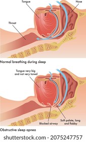 Medical illustration of the consequences of obstructive sleep apnea.