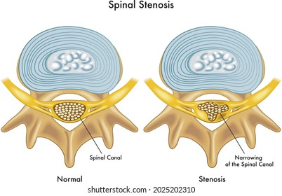 Medical illustration of the consequences of spinal stenosis.