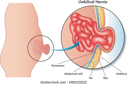 Medical illustration of the consequences of umbilical hernia.