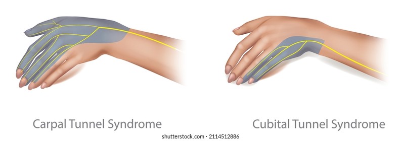 Ilustración médica del Síndrome del Túnel Cubital y Carpal. Mediana y nerviosismo ulnar comprimido. Vector