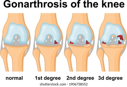 Medical illustration of the degrees of gonarthrosis of the knee