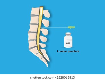 Ilustração médica representando um procedimento de punção lombar, mostrando uma agulha acessando o canal espinhal para coletar líquido cefalorraquidiano (LCR).