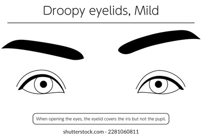 Medical illustration: Diagram of mild ptosis (eyelid drooping), Vector Illustration