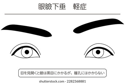 Medical illustration: Diagram of mild ptosis (eyelid drooping) - Translation: When opening the eyes, the eyelid covers the iris but not the pupil.