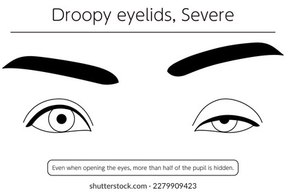 Medical illustration: Diagram of severe ptosis (eyelid drooping), Vector Illustration