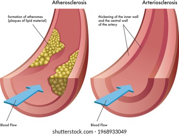 Medizinische Veranschaulichung der Unterschiede zwischen Atherosklerose und Arteriosklerose, mit Anmerkungen.