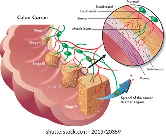 Medical Illustration Of The Different Stages Of Colon Cancer.