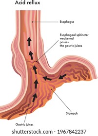 Medical illustration of the effects of the acid reflux.