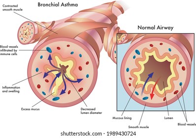 Medical Illustration Of The Effects Of Bronchial Asthma.