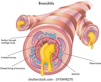 Medical illustration of the effects of the bronchitis, with annotations.