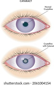 Medical illustration of the effects of cataract.