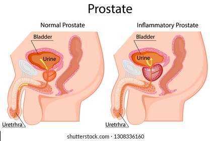 nonbacterial prostatitis)