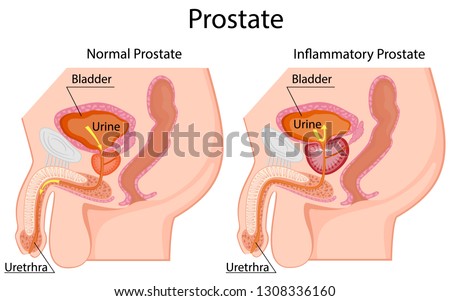 Medical illustration of the effects of prostatitis