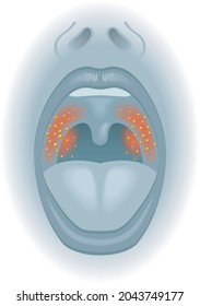 Medical illustration of the effects of sore throat.