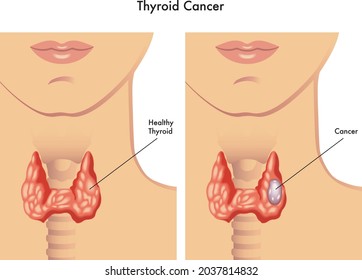 Medical illustration of the effects of the thyroid cancer.