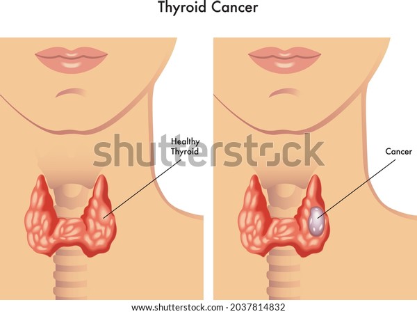 Medical illustration of the effects of the\
thyroid cancer.