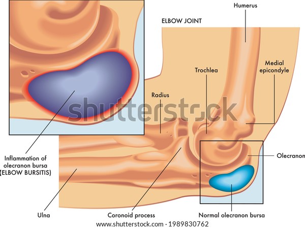 A medical illustration of elbow bursitis\
symptoms with annotations.