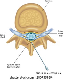 Medical illustration of epidural anesthesia, isolated on a white background.