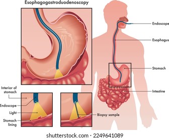 Medizinische Veranschaulichung einer Esophagogastroduodenoskopie mit zwei Details, die das verwendete Verfahren und die verwendeten Instrumente mit Anmerkungen zeigen.