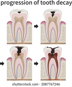 medical illustration explaining the progression of tooth decay