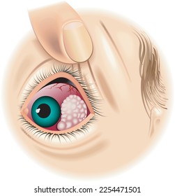 Medical illustration of an eye with tumor.