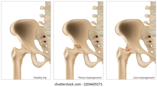 Medical illustration of the Femoroacetabular Impingement. Different of the Cam impingement and Pincer impingement. Healthy hip